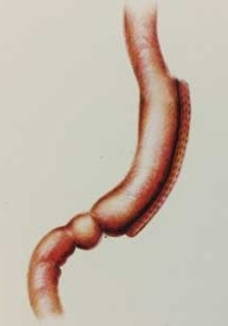 Sleeve Gastrectomy